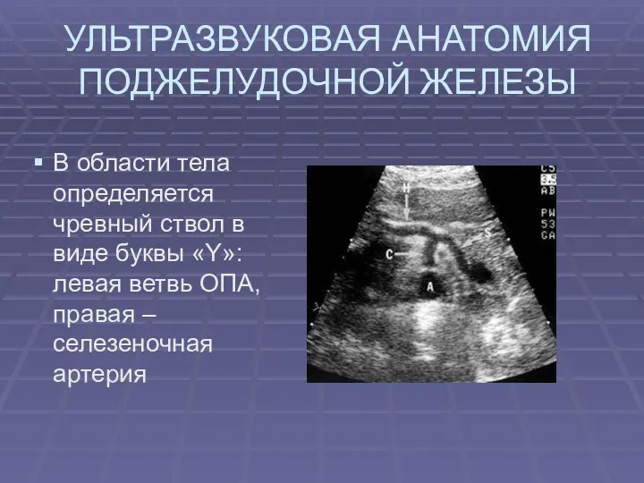 УЛЬТРАЗВУКОВАЯ АНАТОМИЯ ПОДЖЕЛУДОЧНОЙ ЖЕЛЕЗЫ В области тела определяется чревный ствол