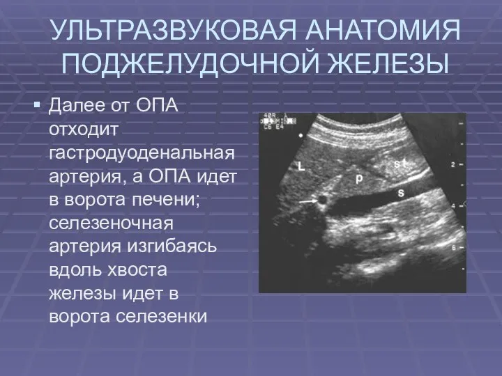 УЛЬТРАЗВУКОВАЯ АНАТОМИЯ ПОДЖЕЛУДОЧНОЙ ЖЕЛЕЗЫ Далее от ОПА отходит гастродуоденальная артерия,