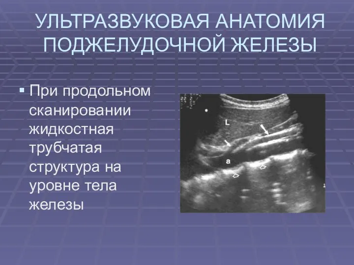 УЛЬТРАЗВУКОВАЯ АНАТОМИЯ ПОДЖЕЛУДОЧНОЙ ЖЕЛЕЗЫ При продольном сканировании жидкостная трубчатая структура на уровне тела железы