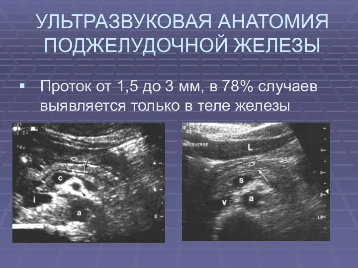 УЛЬТРАЗВУКОВАЯ АНАТОМИЯ ПОДЖЕЛУДОЧНОЙ ЖЕЛЕЗЫ Проток от 1,5 до 3 мм,