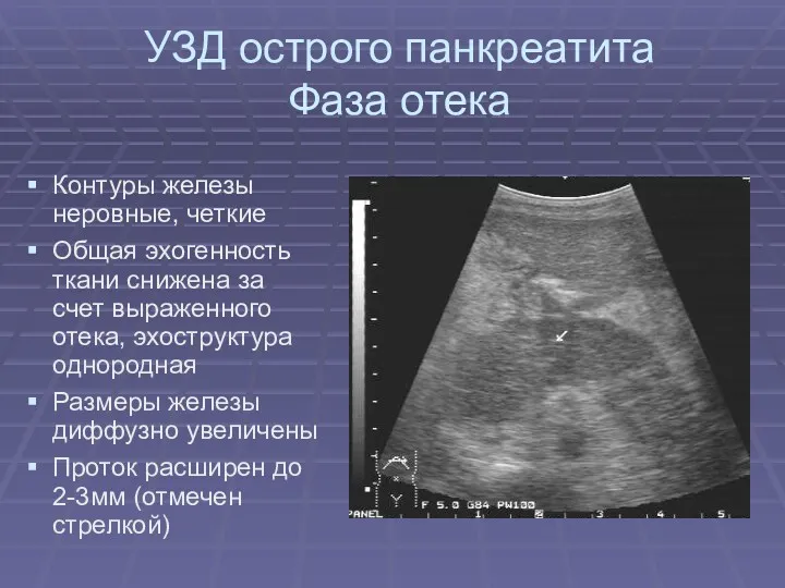 УЗД острого панкреатита Фаза отека Контуры железы неровные, четкие Общая