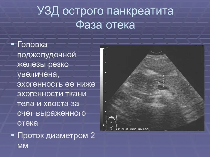 УЗД острого панкреатита Фаза отека Головка поджелудочной железы резко увеличена,