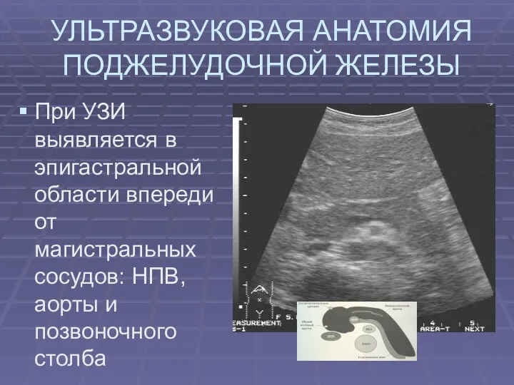 УЛЬТРАЗВУКОВАЯ АНАТОМИЯ ПОДЖЕЛУДОЧНОЙ ЖЕЛЕЗЫ При УЗИ выявляется в эпигастральной области