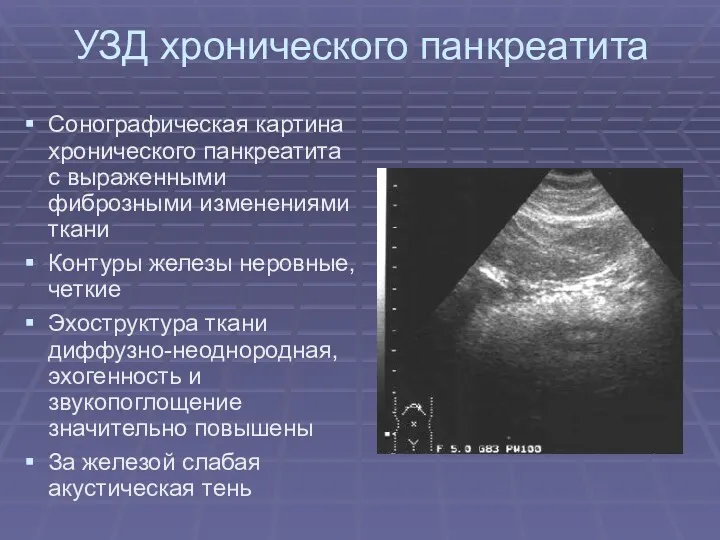 УЗД хронического панкреатита Сонографическая картина хронического панкреатита с выраженными фиброзными