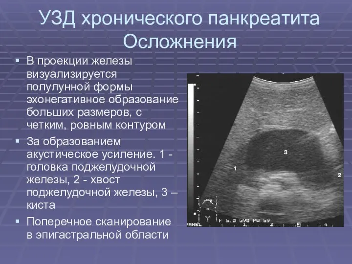 УЗД хронического панкреатита Осложнения В проекции железы визуализируется полулунной формы