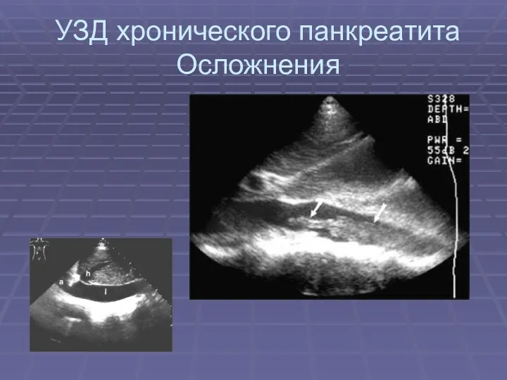 УЗД хронического панкреатита Осложнения