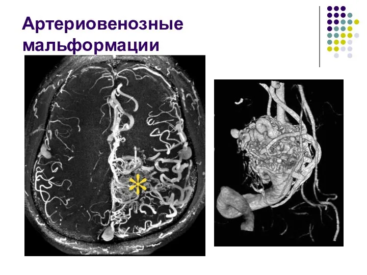 Артериовенозные мальформации