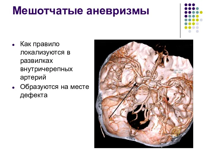 Мешотчатые аневризмы Как правило локализуются в развилках внутричерепных артерий Образуются на месте дефекта