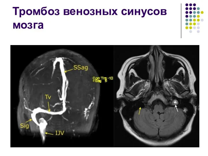 Тромбоз венозных синусов мозга