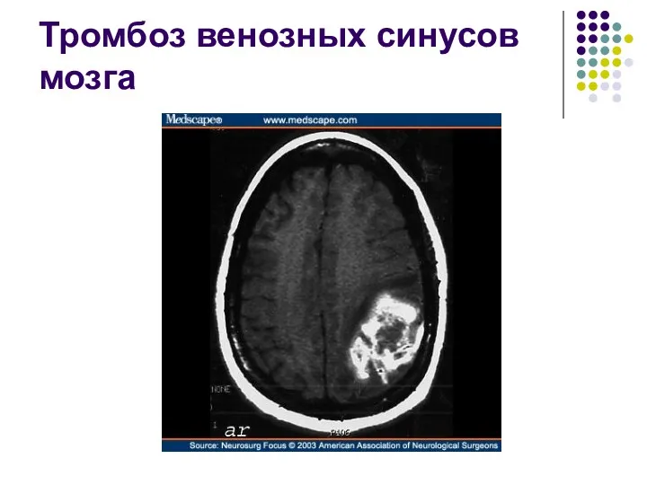 Тромбоз венозных синусов мозга