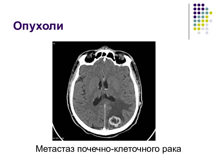 Опухоли Метастаз почечно-клеточного рака