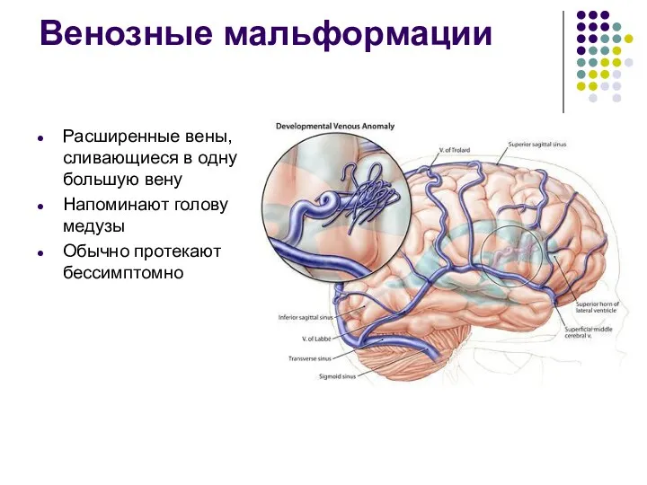 Венозные мальформации Расширенные вены, сливающиеся в одну большую вену Напоминают голову медузы Обычно протекают бессимптомно