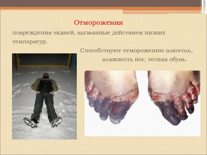 Отморожения повреждения тканей, вызванные действием низких температур. Способствуют отморожению алкоголь, влажность ног, тесная обувь.