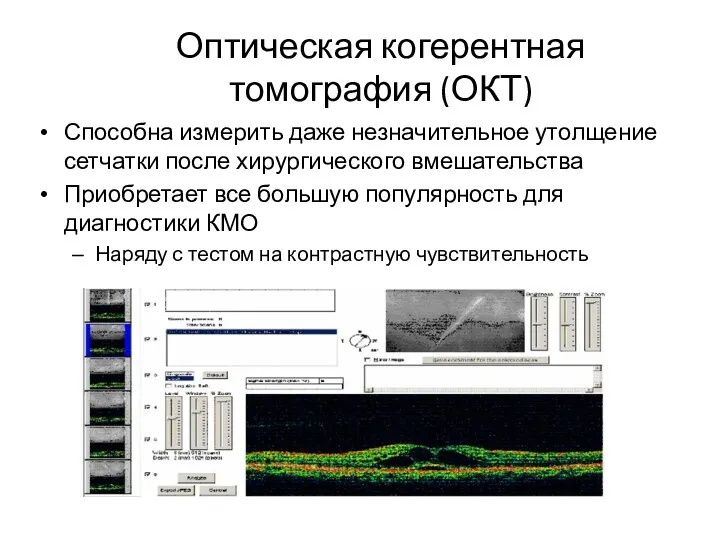 Оптическая когерентная томография (ОКТ) Способна измерить даже незначительное утолщение сетчатки