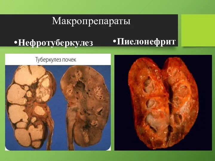Макропрепараты Нефротуберкулез Пиелонефрит