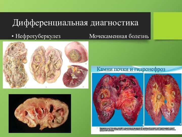 Дифференциальная диагностика Нефротуберкулез Мочекаменная болезнь