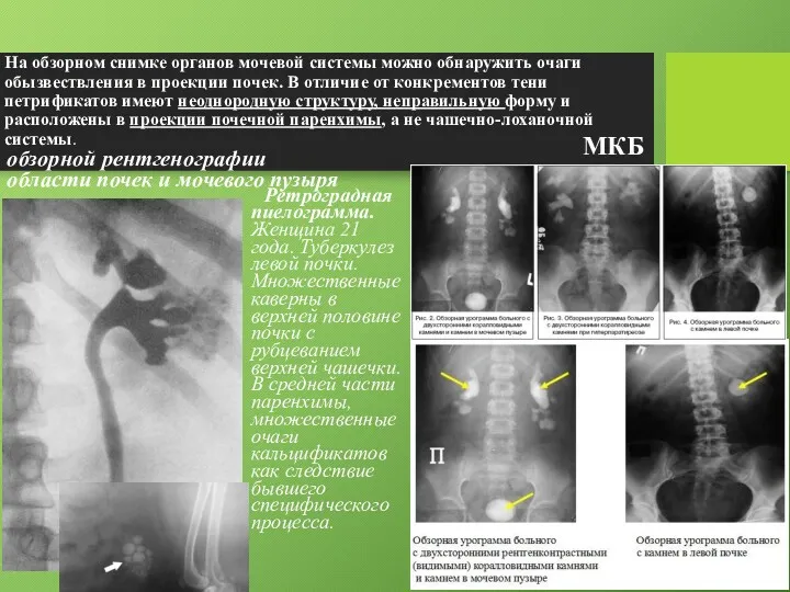 На обзорном снимке органов мочевой системы можно обнаружить очаги обызвествления