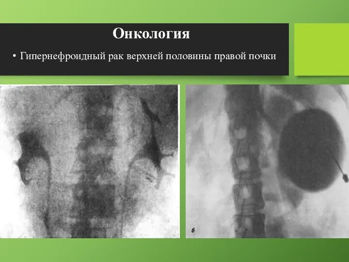 Онкология Гипернефроидный рак верхней половины правой почки