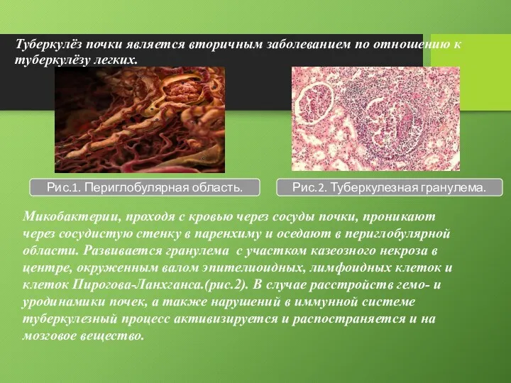 Туберкулёз почки является вторичным заболеванием по отношению к туберкулёзу легких.