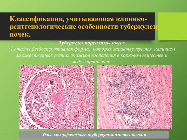 Классификация, учитывающая клинико-рентгенологические особенности туберкулеза почек. Туберкулез паренхимы почек (1