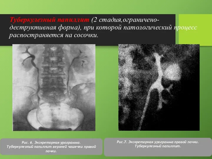 Туберкулезный папиллит (2 стадия,ограничено-деструктивная форма), при которой патологический процесс распостраняется