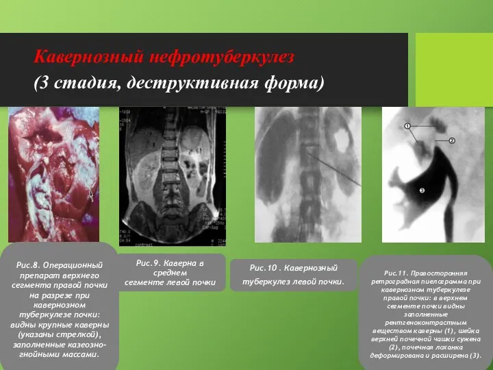 Кавернозный нефротуберкулез (3 стадия, деструктивная форма) Рис.10 . Кавернозный туберкулез