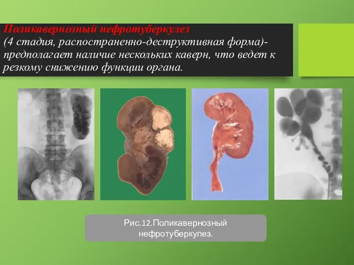 Поликавернозный нефротуберкулез (4 стадия, распостраненно-деструктивная форма)- предполагает наличие нескольких каверн,