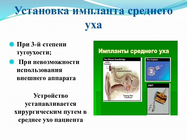 Установка импланта среднего уха При 3-й степени тугоухости; При невозможности использования внешнего аппарата