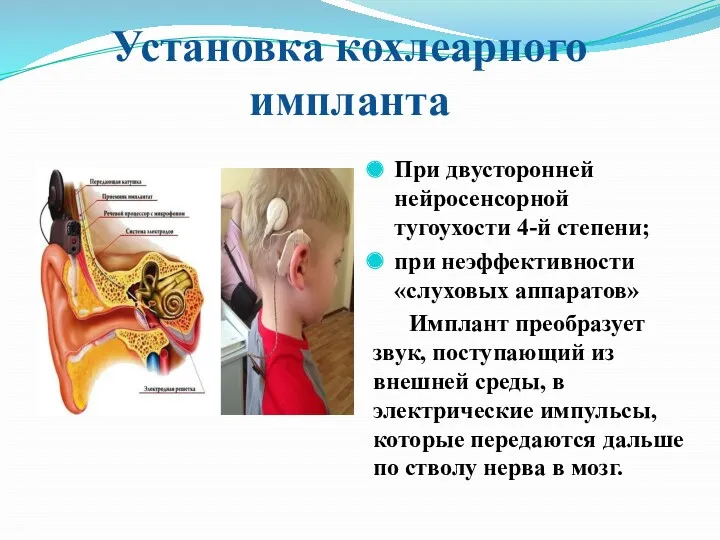 Установка кохлеарного импланта При двусторонней нейросенсорной тугоухости 4-й степени; при неэффективности «слуховых аппаратов»