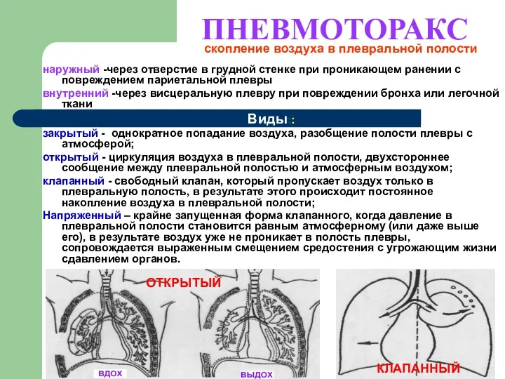 ПНЕВМОТОРАКС наружный -через отверстие в грудной стенке при проникающем ранении