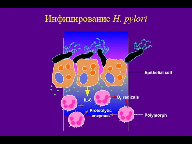 IL-8 Proteolytic enzymes O2 radicals Инфицирование H. pylori Epithelial cell Polymorph