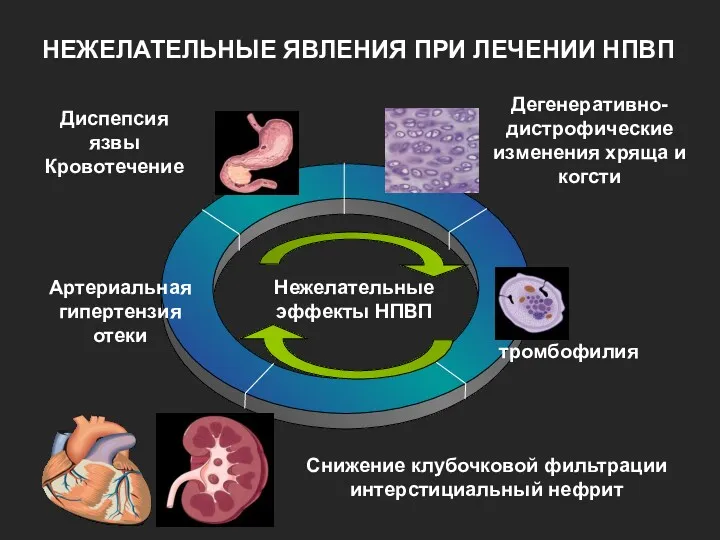 НЕЖЕЛАТЕЛЬНЫЕ ЯВЛЕНИЯ ПРИ ЛЕЧЕНИИ НПВП Диспепсия язвы Кровотечение Дегенеративно-дистрофические изменения