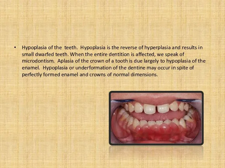 Hypoplasia of the teeth. Hypoplasia is the reverse of hyperplasia and results in