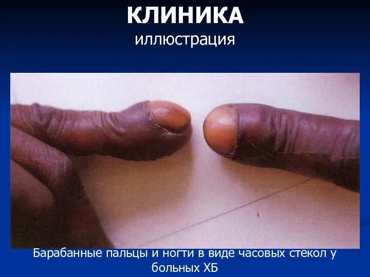 КЛИНИКА иллюстрация Барабанные пальцы и ногти в виде часовых стекол у больных ХБ