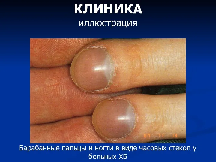 КЛИНИКА иллюстрация Барабанные пальцы и ногти в виде часовых стекол у больных ХБ