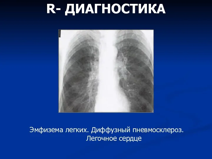 R- ДИАГНОСТИКА Эмфизема легких. Диффузный пневмосклероз. Легочное сердце