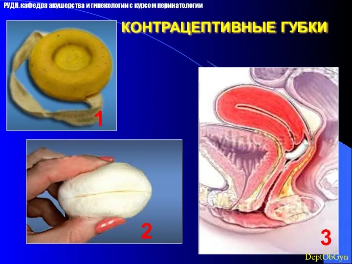 КОНТРАЦЕПТИВНЫЕ ГУБКИ 1 2 3 РУДН, кафедра акушерства и гинекологии с курсом перинатологии DeptObGyn