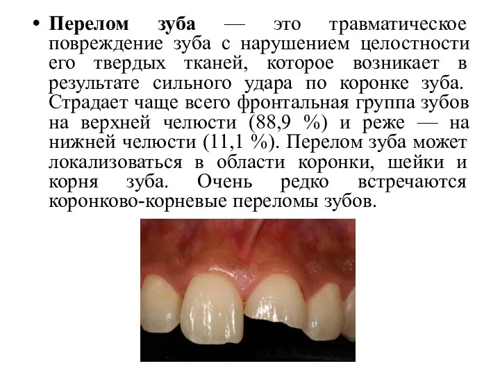 Перелом зуба — это травматическое повреждение зуба с нарушением целостности