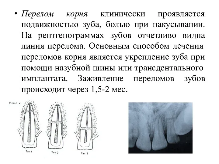 Перелом корня клинически проявляется подвижностью зуба, болью при накусывании. На