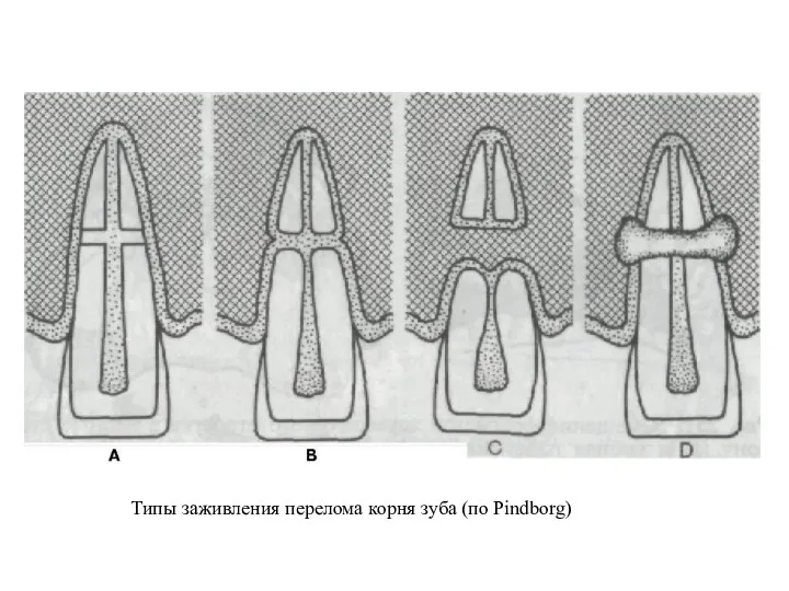 Типы заживления перелома корня зуба (по Pindborg)