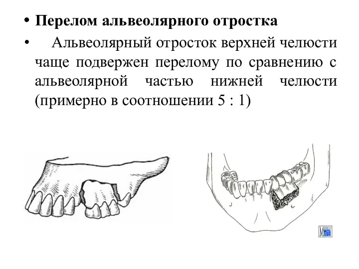 Перелом альвеолярного отростка Альвеолярный отросток верхней челюсти чаще подвержен перелому