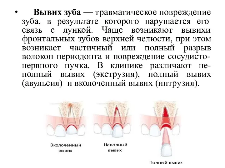 Вывих зуба — травматическое повреждение зуба, в результате которого нарушается