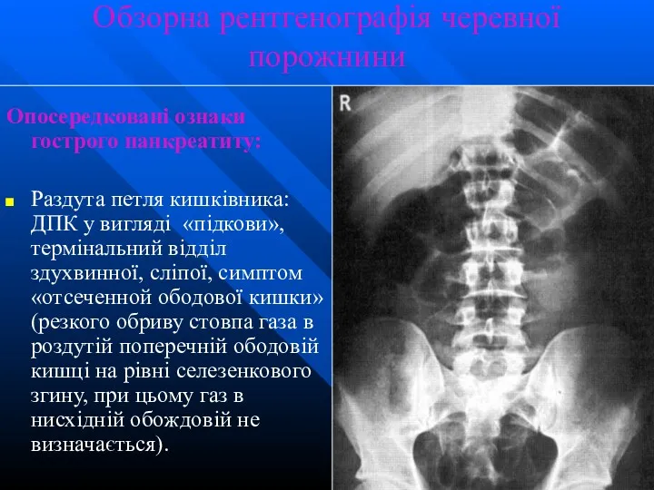 Обзорна рентгенографія черевної порожнини Опосередковані ознаки гострого панкреатиту: Раздута петля