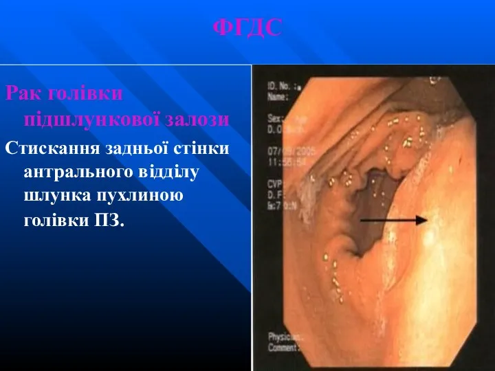 ФГДС Рак голівки підшлункової залози Стискання задньої стінки антрального відділу шлунка пухлиною голівки ПЗ.