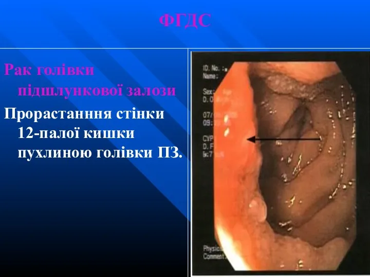 ФГДС Рак голівки підшлункової залози Прорастанння стінки 12-палої кишки пухлиною голівки ПЗ.