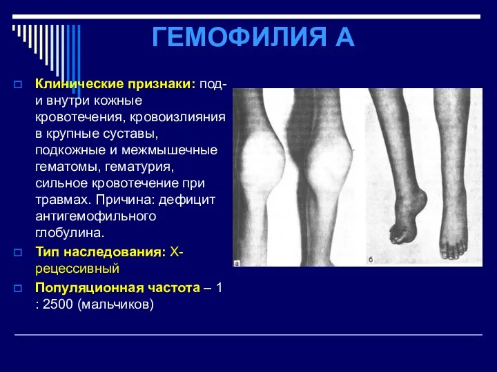 ГЕМОФИЛИЯ А Клинические признаки: под- и внутри кожные кровотечения, кровоизлияния