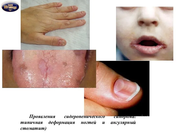 Проявления сидеропенического синдрома: типичная деформация ногтей и ангулярный стоматит)