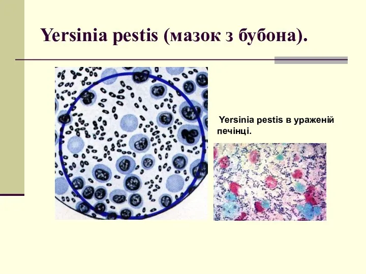 Yersinia pestis (мазок з бубона). Yersinia pestis в ураженій печінці.