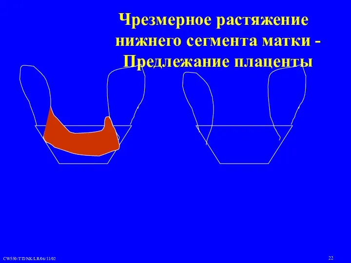 Чрезмерное растяжение нижнего сегмента матки - Предлежание плаценты