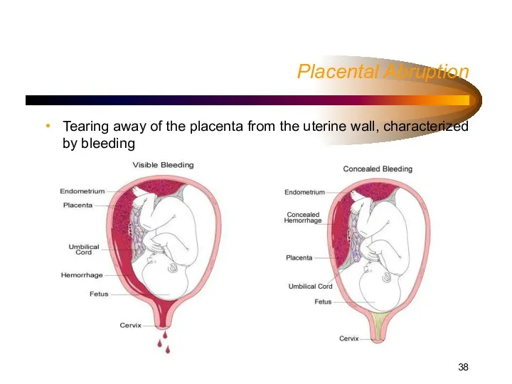 Placental Abruption Tearing away of the placenta from the uterine wall, characterized by bleeding
